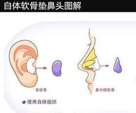 耳软骨移植能降低膨体隆鼻术后鼻尖感染率