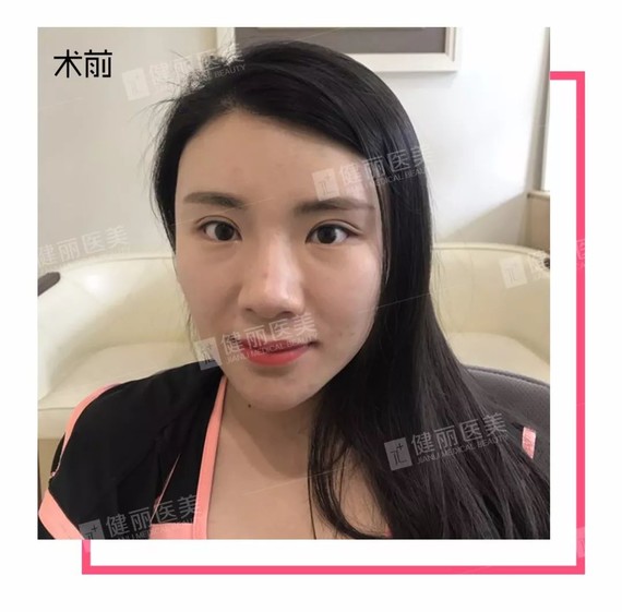 做完鼻综合后,她从土气小妹逆袭洋气少女!如果