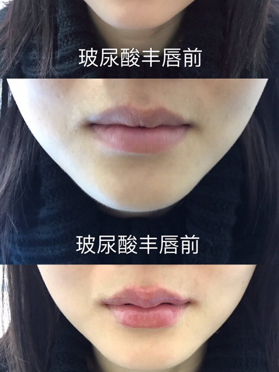 我的美唇之路—玻尿酸丰唇韩式嘟嘟唇体验分享