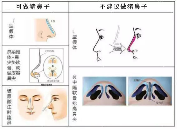 隆鼻后不能做猪鼻子吗?