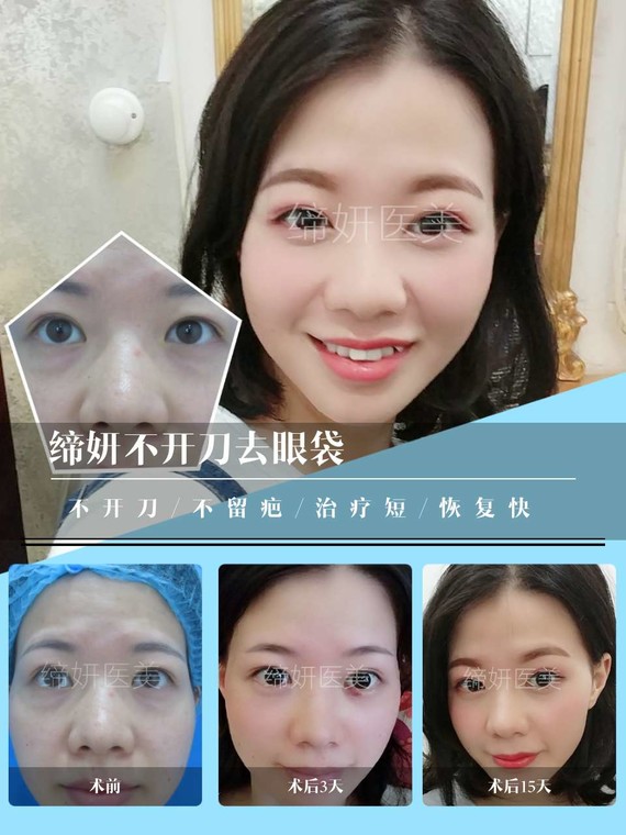 去眼袋的误区和治疗方案很多人都有眼袋重的困扰,眼袋