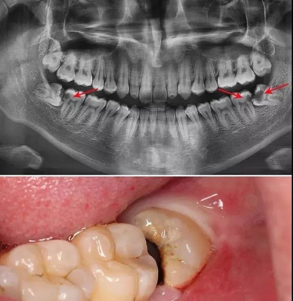 智齿,又叫第三磨牙,是生长在牙列最末端的牙齿,很多人叫它"尽头牙"