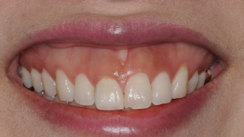 上唇肌肉提起笑容力量过大的情况,导致牙龈