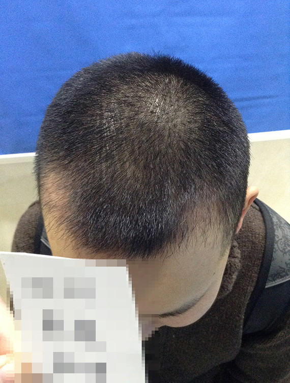这几年发际线越来越高了,尤其两边脱得比较严