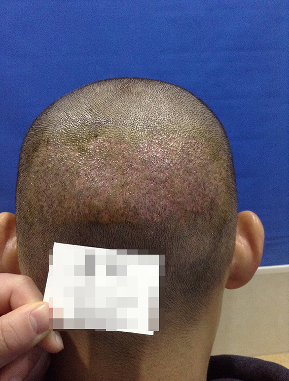 这几年发际线越来越高了,尤其两边脱得比较严