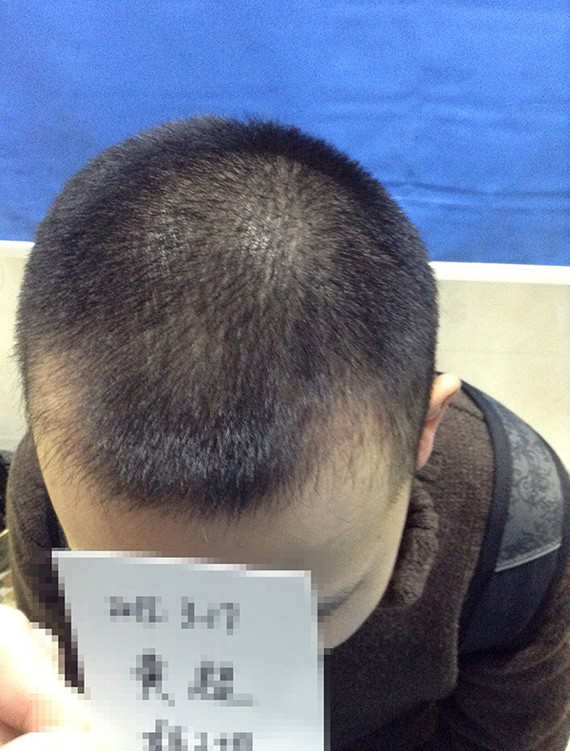 这几年发际线越来越高了,尤其两边脱得比较严