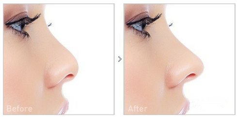 雕鼻,鼻子做线雕好吗,线雕隆鼻多久可以恢复,刷
