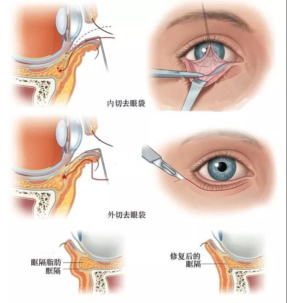 倘若已经出现了眼袋, 非手术方法往往难以改善,只有手术切除的效果最