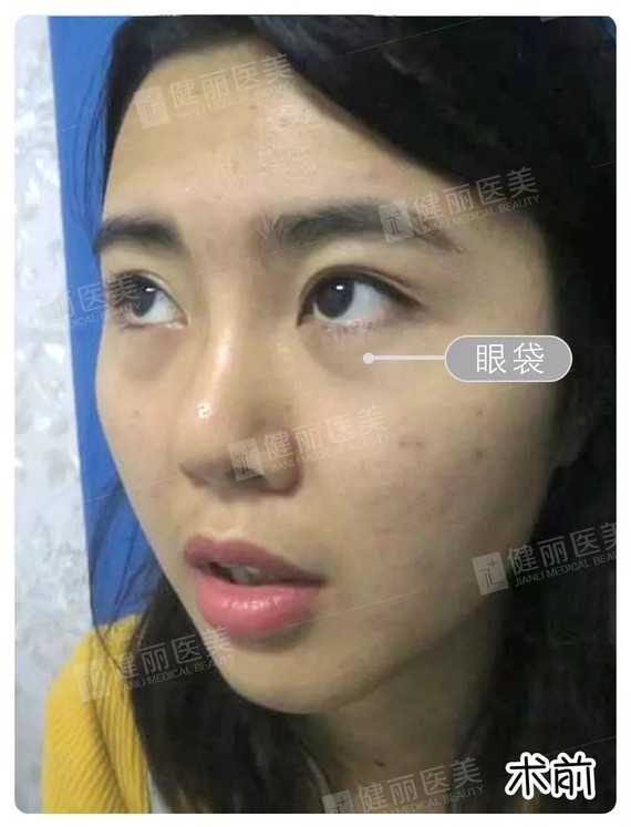 就因为一对大眼袋 总是被老公吐槽很 憔悴 百度了很多去眼袋方法 什么