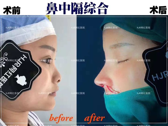 鼻中隔综合,改善中面部凹陷的问题～整体五官都挺拔起来～瞬间气质大