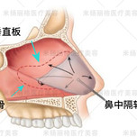 隆鼻,为什么首选鼻中隔现代综合鼻整形术中可用到的软骨材料主要有:鼻