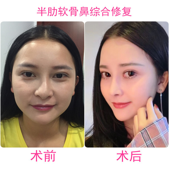 术前分析:姑娘术前鼻梁歪斜,鼻小柱下垂,鼻头圆钝,鼻型不佳   手术