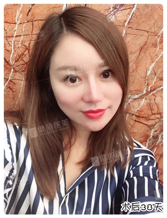 去眼袋8天后,34岁的她竟然被夸年轻似少女?