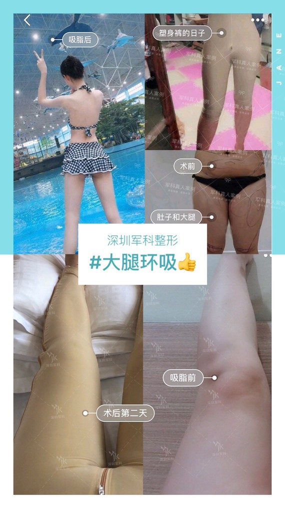 选择大腿环吸准没错  快速抽取腿部堆积脂肪   术后即铅笔腿型完美