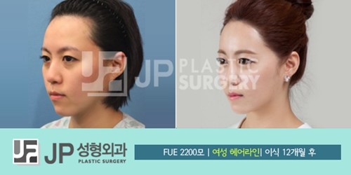 韩国JP整形外科医院毛发移植手术效果怎么样