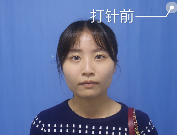 微整形|术后当自强|国内整形|昆明同城|广州同城|v明星笔明星断食减肥法案例图片