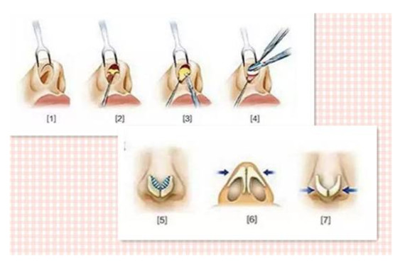 鼻头缩小一定会增生吗?鼻头缩小术切除过软组织容易增生不是所有的鼻头缩小手_圈子-新氧美容整形