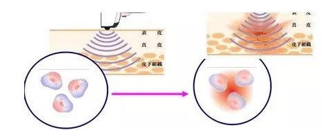 肥胖纹如何去除肥胖纹顾名思义是肥胖引起的。