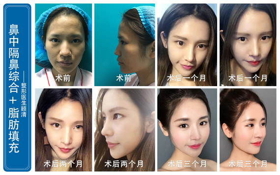 ?刚做完面部猪头填充,脸肿的跟主题一样?男女班会脂肪v面部生图片