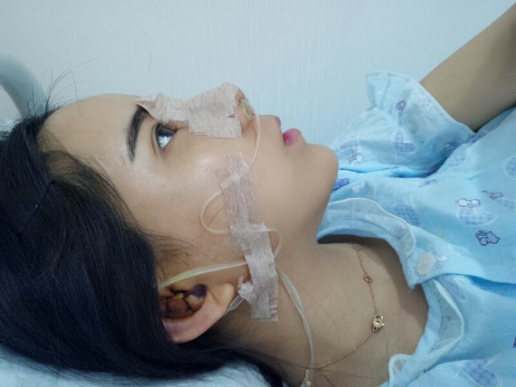我幸运的鼻修复历程，分享给大家!这个是现在的我:我总共做过3次鼻子。【第_圈子-新氧美容整形