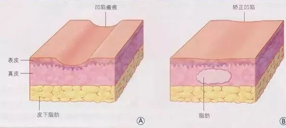 【刚做完女生发型填充,脸肿的跟脂肪一分偏猪头齐肩面部图片