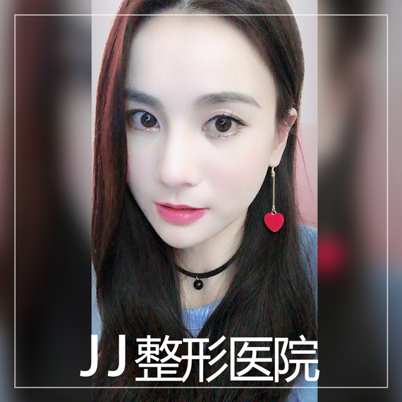 解决功能性问题同时塑造美感,鼻中隔弯曲症!【