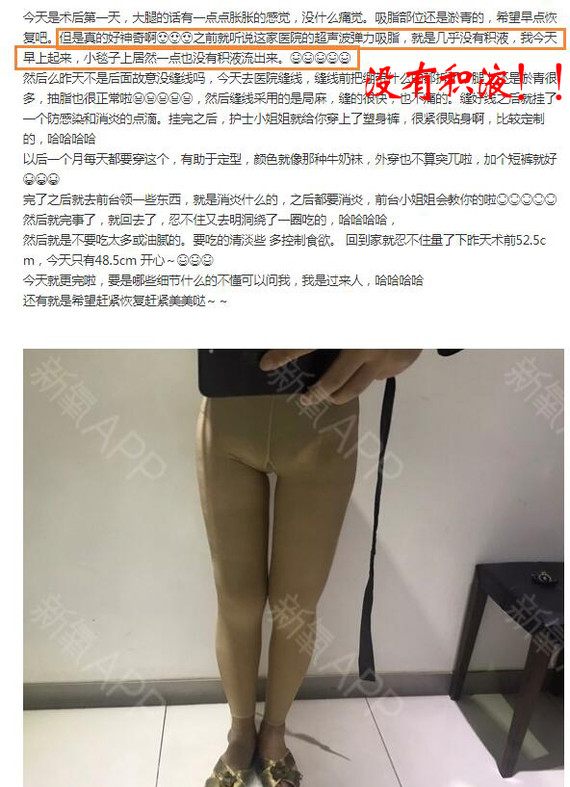 大腿吸脂术后无积液?也没有什么痛感?