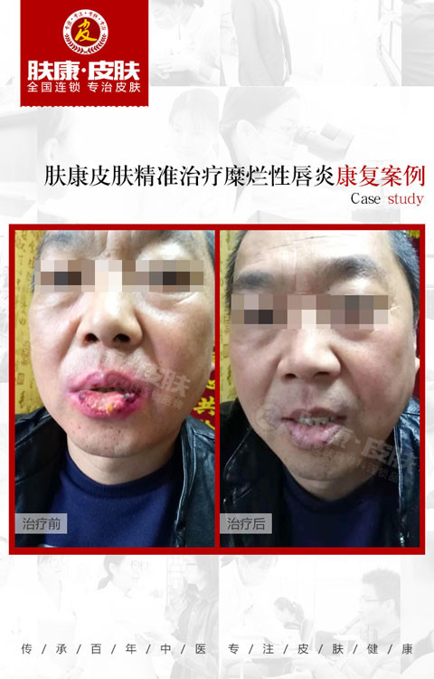 患者郑先生在广州某医院治疗痤疮一周后病情严