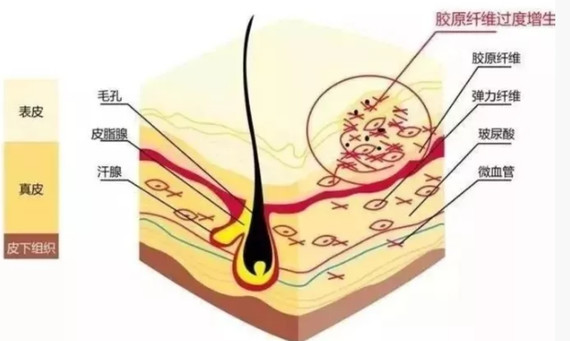 剖腹产留疤,涂生姜可防止疤痕增生?如果你是剖