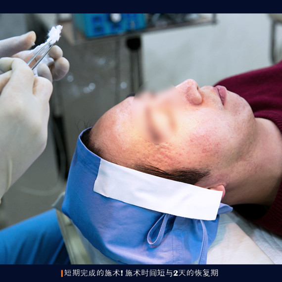本院的自体真皮再生术治疗脸部青春痘疤痕介绍