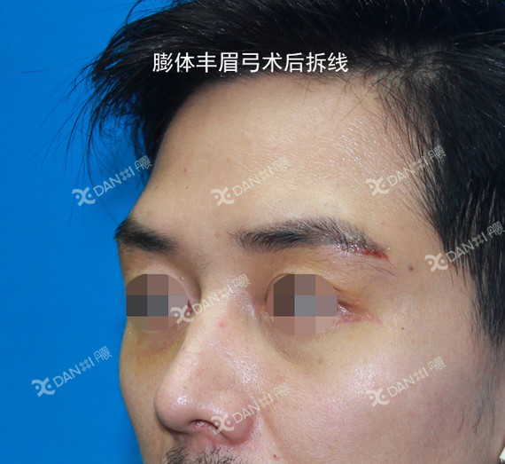 分享一例男士假体丰眉弓案例(立秀加强型膨体)术前