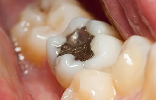 【补牙后注意事项】补牙是指用人造物质修补牙