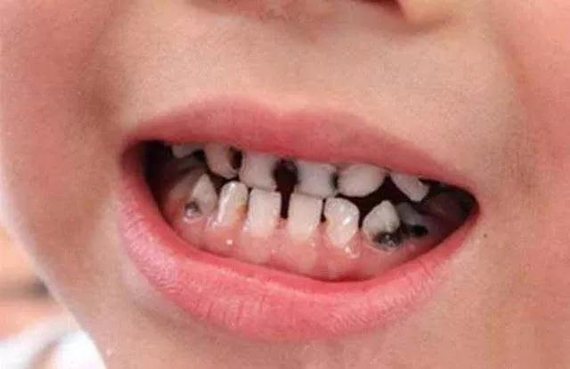 95%的中国人都在无形中伤害牙齿!那你呢?