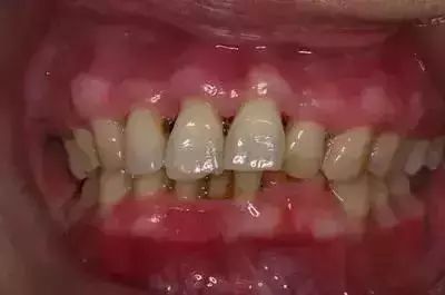 牙齿的稳固是依靠牙龈,牙槽骨,牙周膜,牙骨质等牙周支持组织稳固