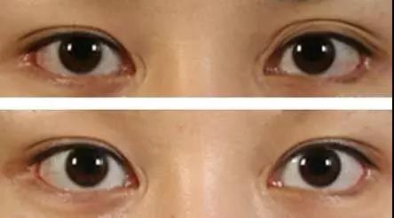 症状:由于去除组织过多,导致上眼睑凹陷,组织粘连,出现多重褶,双眼皮