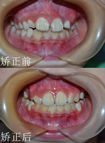 8岁小患者替牙期牙齿前突,预防性拔牙矫正_圈子-新氧美容整形