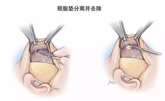 关于去夹脂垫你知道多少?瓜子脸一直美丽脸型