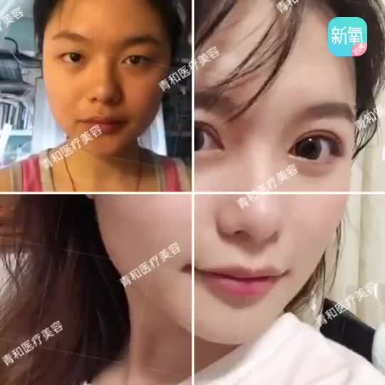 双眼皮怎么做好看?我眉弓高,可以做欧式么?