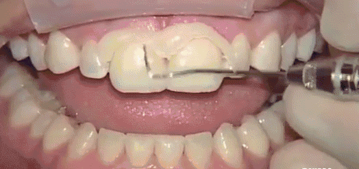 牙齿颜色,形态不好看,怎么一次性解决?