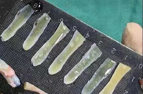 肋软骨鼻整形的发展 | 榫卯结构整体鼻头支架