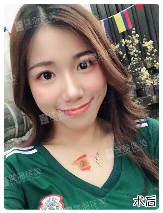 新氧- 成都健丽医美 | 眼部 | 眼袋 | 成都同城 | 真人案例 | 巨变