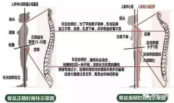 最明显的特征,周冬雨那个就很典型,而且得骨盆后倾的很容易腰间盘突出