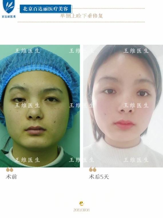 北京百达丽#王维医生##上睑下垂修复#案例:姑娘术