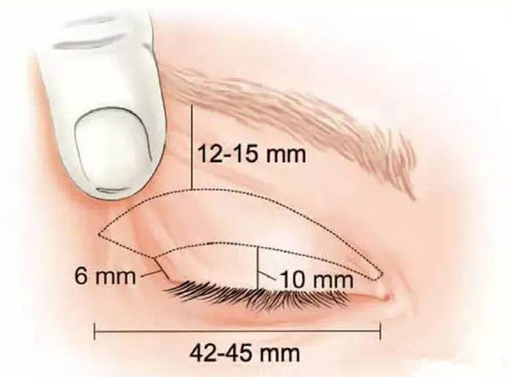 重睑手术对眼功能问题的几点考虑