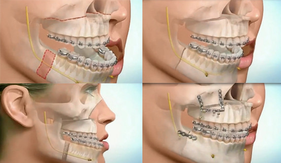 上颌前突,而导致牙齿前突,所以关键要通过正颌手术来解决