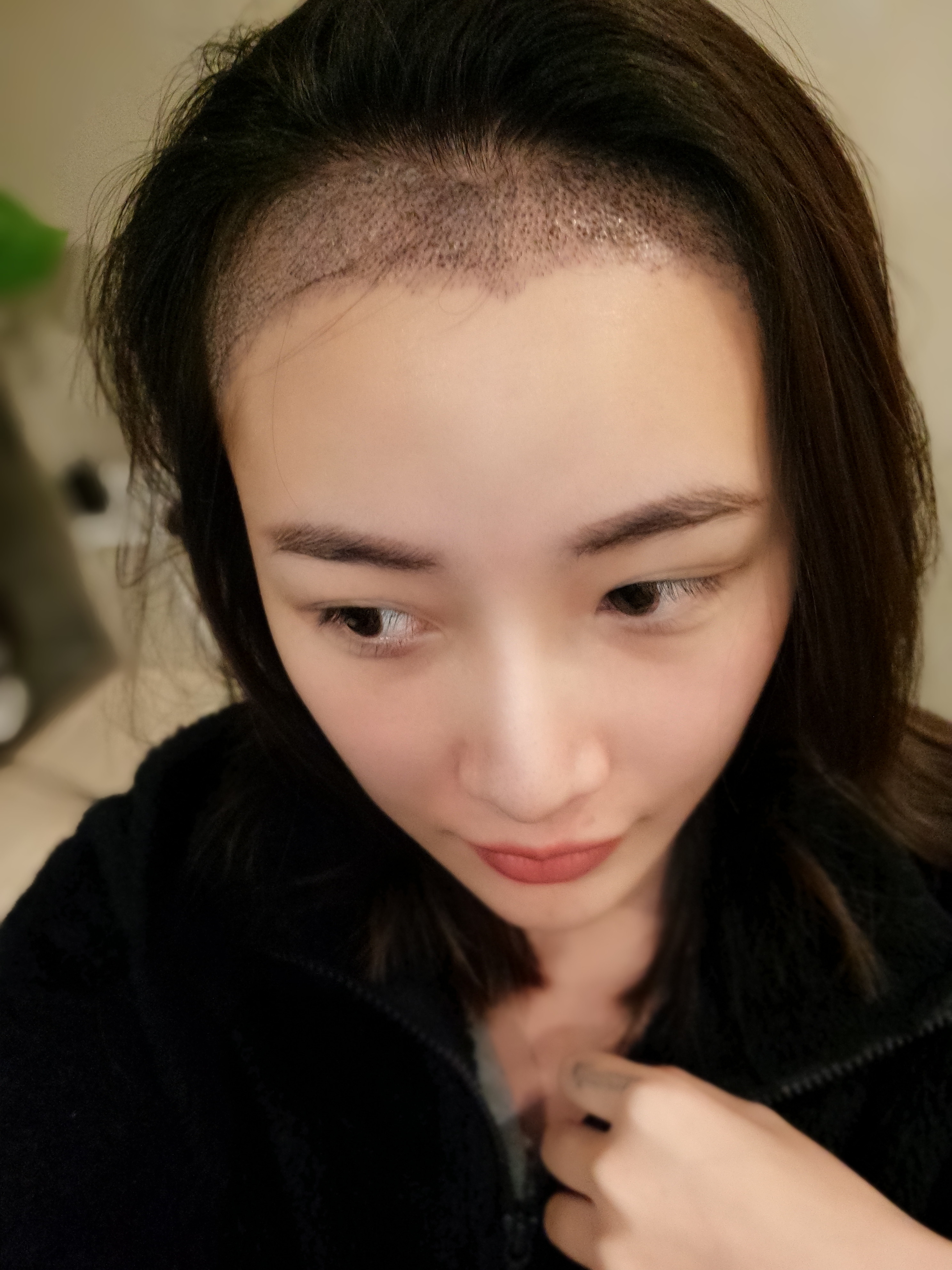 1月23日 发际线是很多女孩子心中的痛,经常会有发友来哭诉自己发际线