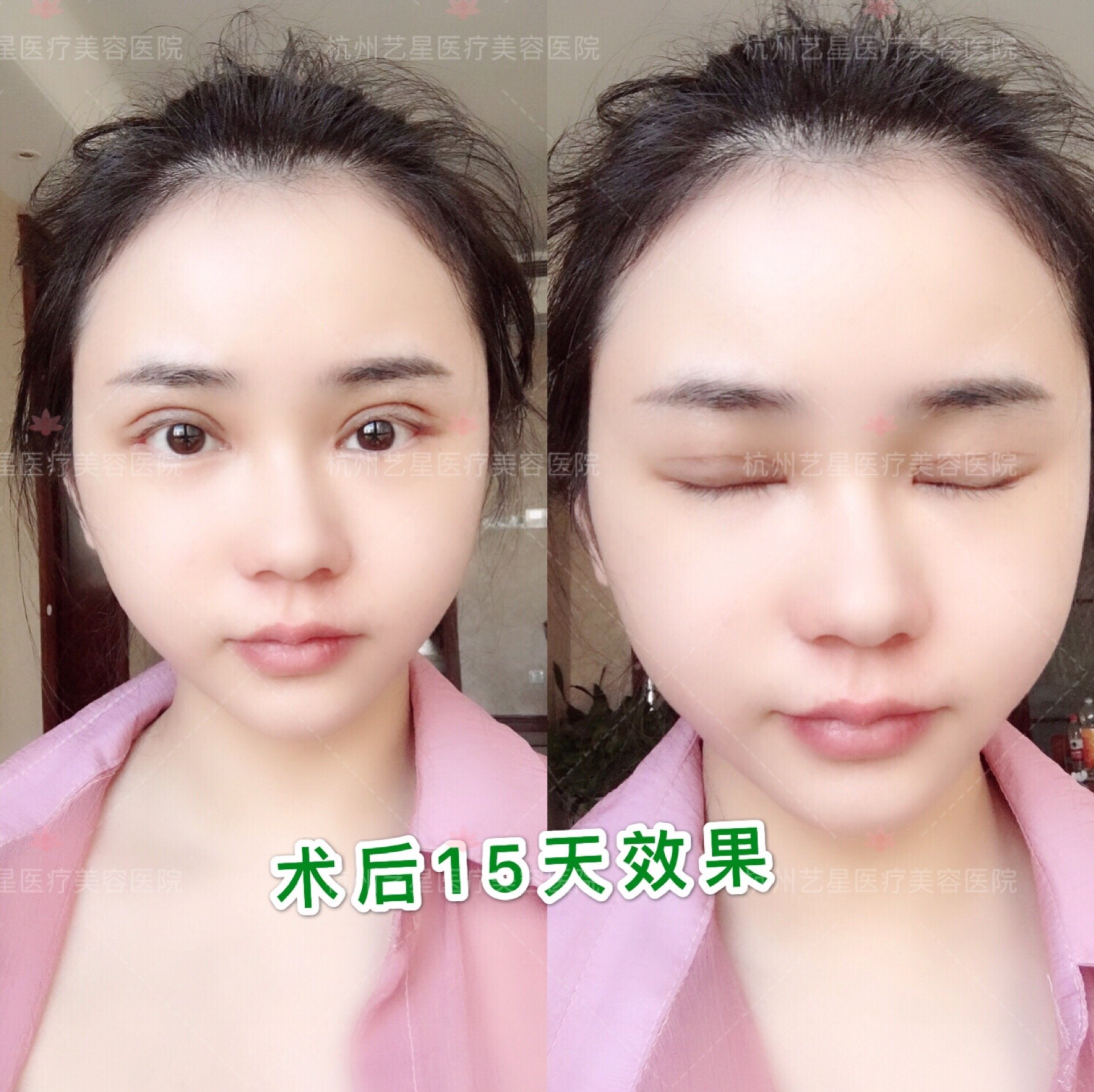一般来说,双眼皮手术后都不会遗留下明显的疤痕的 但手术后伤口愈合