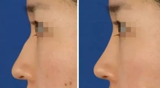 驼峰鼻是什么#简单来说,驼峰鼻是先天性畸形的一种_圈子-新氧美容