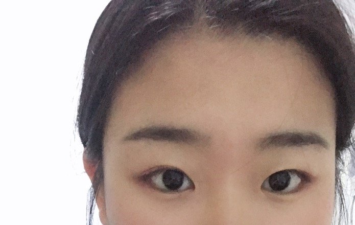 我的眼距我来定——晒眼距_圈子-新氧美容整形