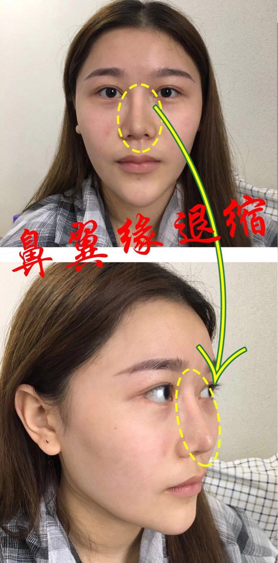 摆脱"猪鼻子",鼻翼缘退缩该如何纠正?很多人很在意
